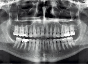 Radiografía en blanco y negro dental